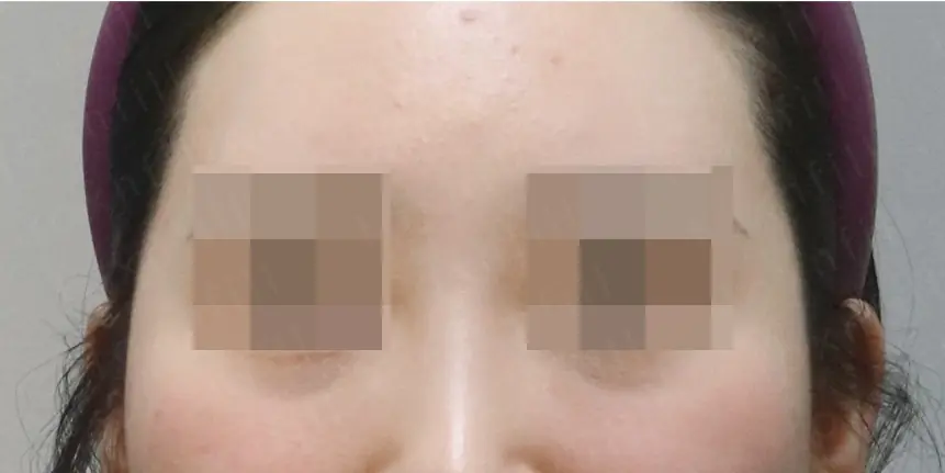시술 전 사진