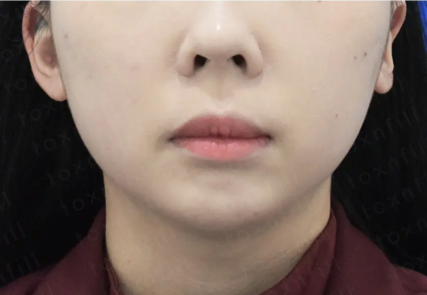 시술 후 사진